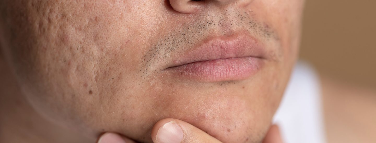 Rosto masculino com cicatrizes de acne na região das bochechas