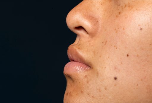 Perfil de rosto feminino com manchas na pele visíveis