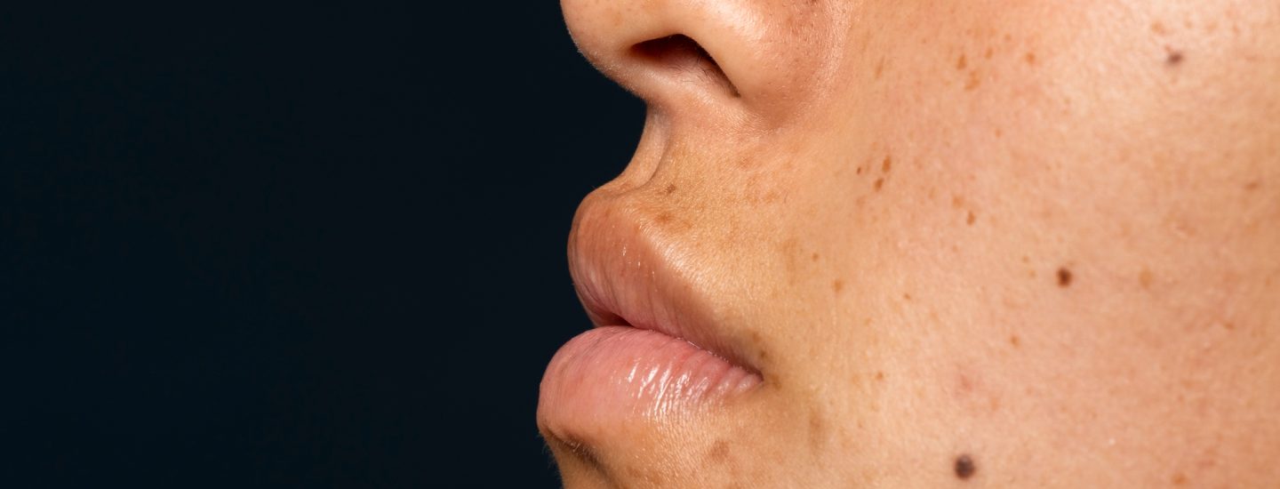 Perfil de rosto feminino com manchas na pele visíveis