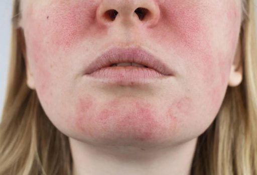 Mulher com rosácea no rosto, representando sintomas da condição inflamatória.